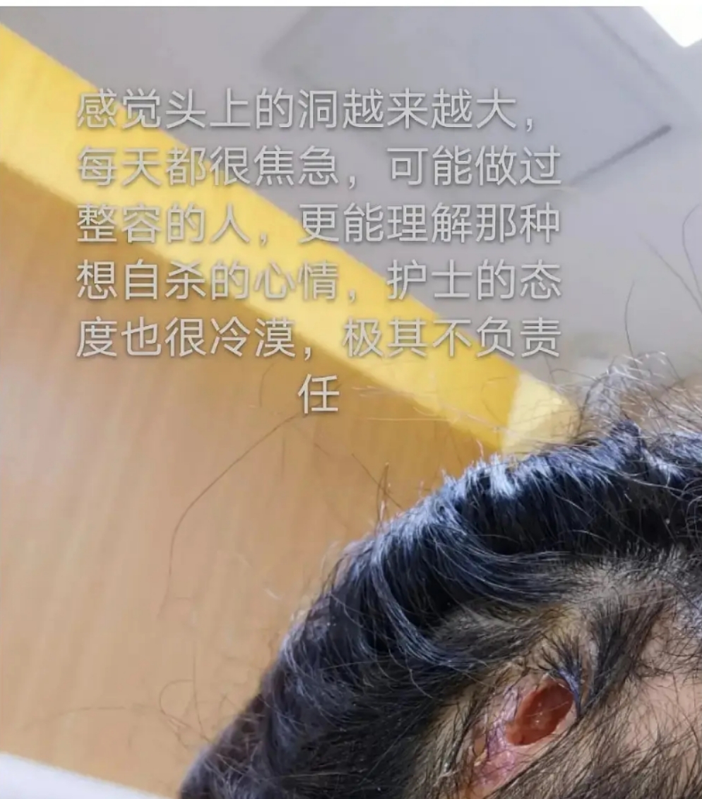 美颜|“自残式医美”有多坑？颅骨注水泥，小腿断神经，分明是邪术