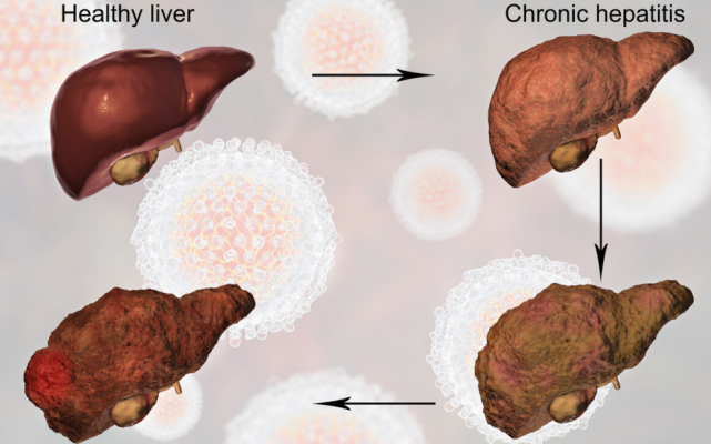 肝癌|体内有癌，皮肤先知! 皮肤若有“3”种异常，可能是肝癌“信号”