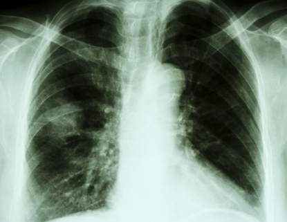 天天听健康 吃一口相当于10斤蜂蜜,中科院士:没事多吃2口,肺功能慢慢强壮