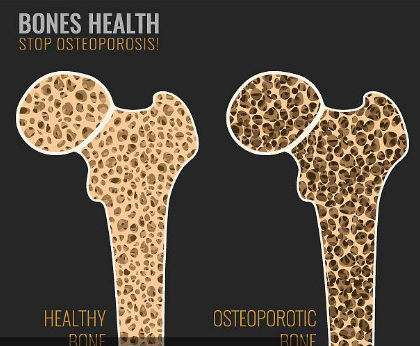 医学小栈|骨科专家：很多病要会治、很多冤枉钱不用花，比如骨质疏松！