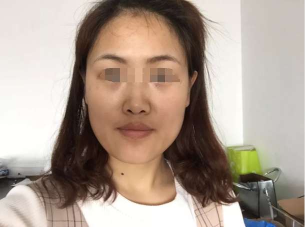 运动|54岁男子查出肺癌，崩溃大哭，医生：其实脸上早有“提醒”，很少人留意