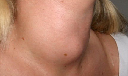 医生|16岁女孩疑似怀孕，甲状腺癌晚期，医生：2水天天喝，是在毒杀甲状腺