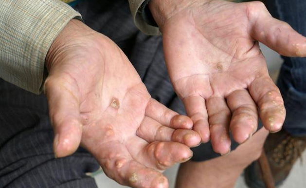 甲状腺结节|尿酸偏高的人，尽量少吃这3种高嘌呤调料，或许对你有帮助