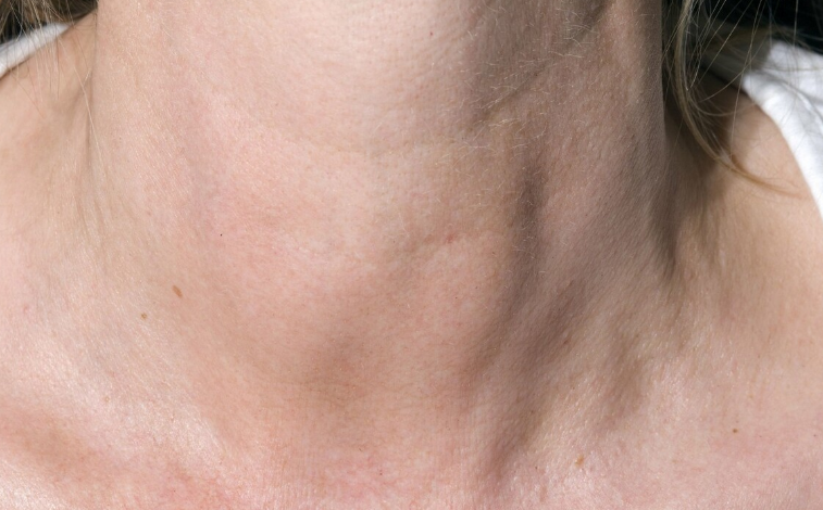 甲状腺|一种“米”比辣椒还毁甲状腺，甲乳科医生：不想甲状腺烂掉，少碰为好