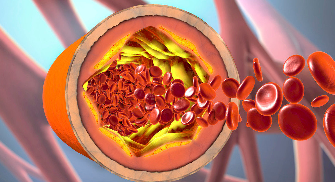 洋葱|血脂“劲敌”已公布，比洋葱厉害，医生：每天坚持吃，血脂稳稳降