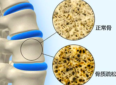 中毒|茄子可能威脅到骨骼健康？這1物放開吃，有助于提高骨骼質量