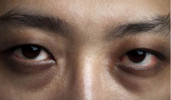 天天听健康 呼吸科主任: 放在开水里一把，如果经常喝，会排出尼古丁，肺会越来越干净