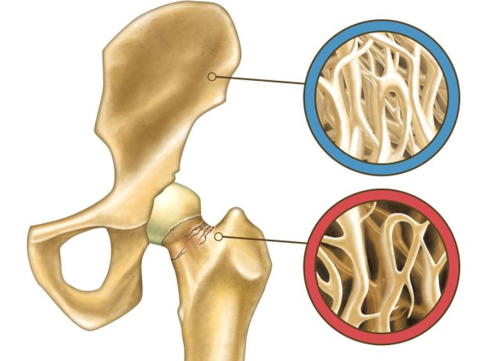 医生|每吃一口都是在骨头上“钻眼”，医生：远离“1绿1白”，不少人还当成宝！