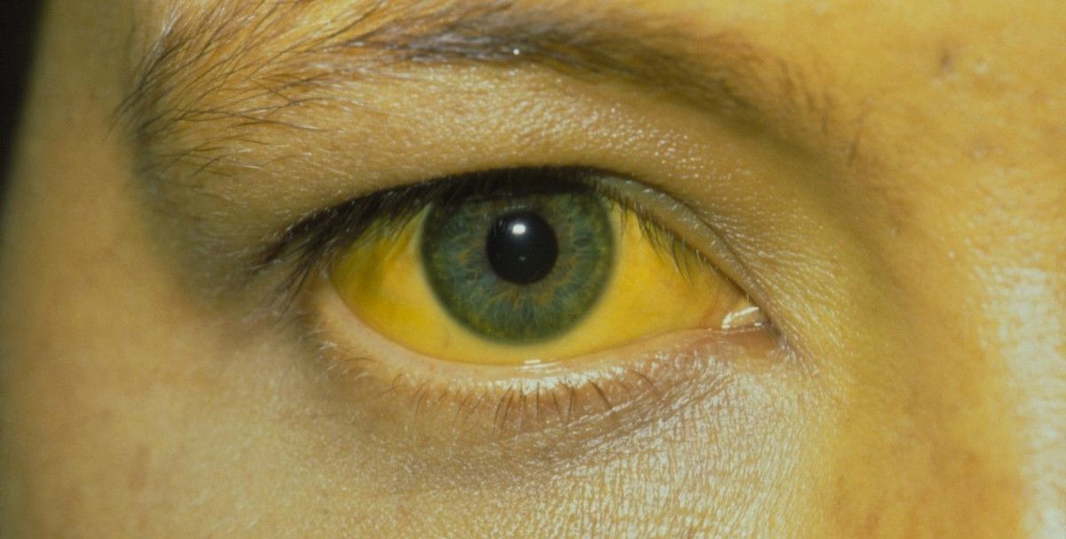 快乐医者|3种早餐被列入伤肝名单，提醒：肝不好的人，最好不要碰