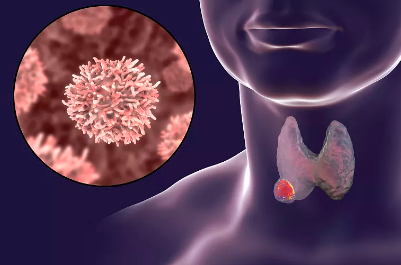 甲状腺癌|甲状腺癌的“祸根”被找到，烟酒末上榜，第一名我们一天也少不了