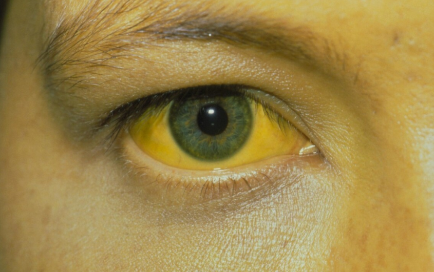 39健康网|32岁男子查出肝癌，化疗后数次离世，医生怒斥：冰箱1物怎可常吃