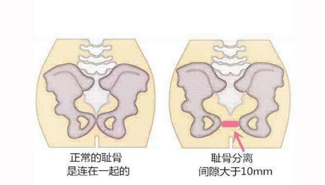 一身狼狈|孕妇在怀孕期间觉得最辛苦的是什么?
