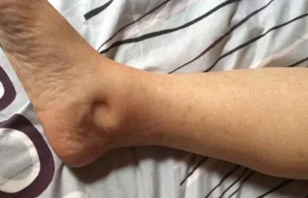 肝脏|“伤肝大王”被发现，专家警告：不想肝脏报废，3物白送也不吃