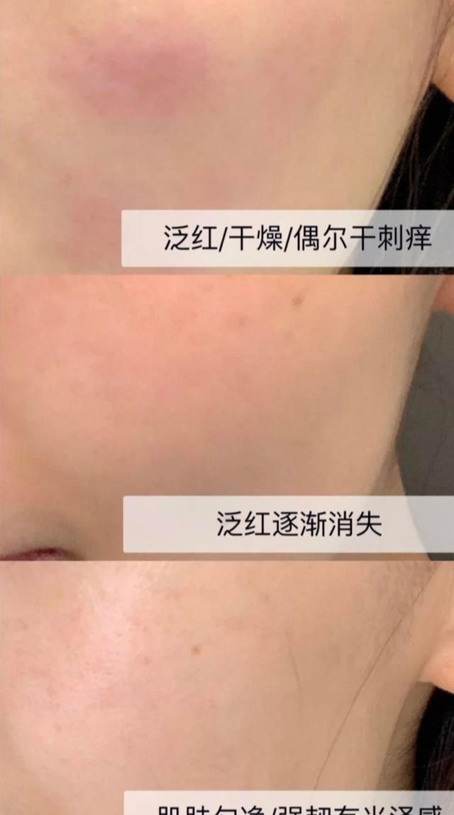 好物官|海南女子为变白，花一万去美容机构注射“美白针”，结果高烧不退