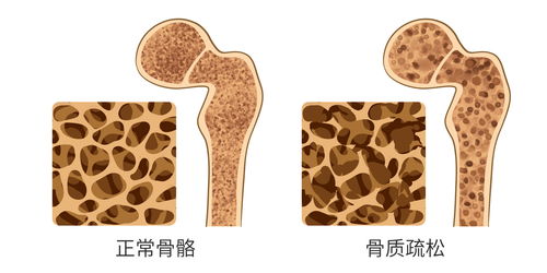 医学小栈|骨科医生提示：3种家常菜被拉入“偷钙”名单，骨疏松的尽量少吃