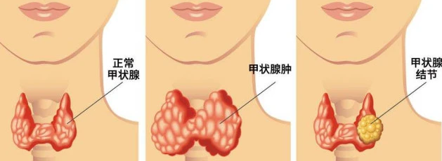 |医生直言:不想让甲状腺结节增大,3种“发物”别再往嘴里塞