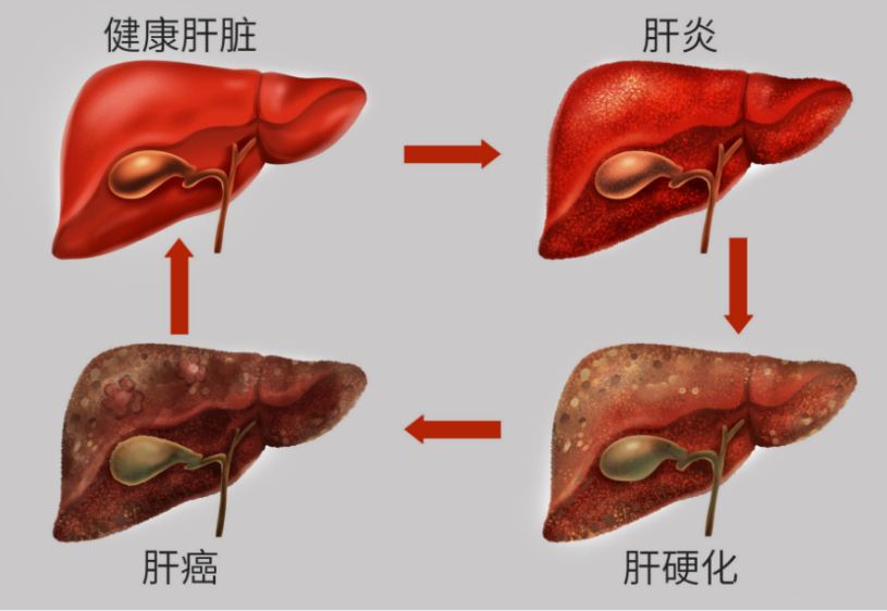 肝脏|42岁男子每天跑步“养肝”，确诊肝硬化晚期，医生：2个习惯害了他