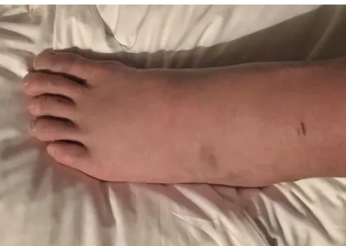 |不论男女，下半身出现4种异常，肺或已“烂如网筛”，一个不占，肺还算健康