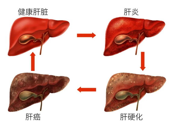 痛经|脂肪肝“罪魁祸首”被发现,不是肥肉,前3名正悄悄挖空你的肝脏