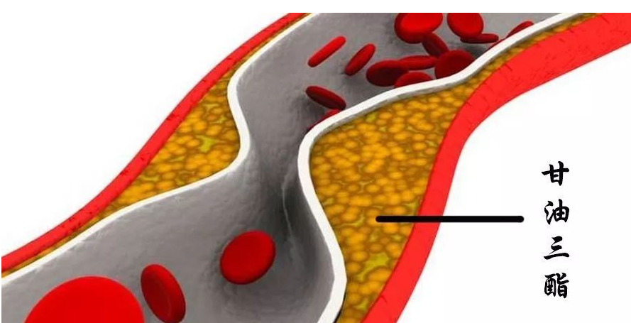 甘油|?甘油三酯“大户”公布，肥肉“蒙冤”，医生：不想血管堵塞上门，尽早戒掉