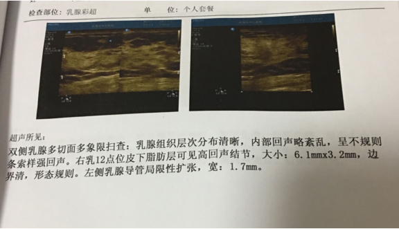 天天听健康|乳腺结节恶化时 ，检查会有4个“异常”，若没有，恭喜你！乳腺还算健康