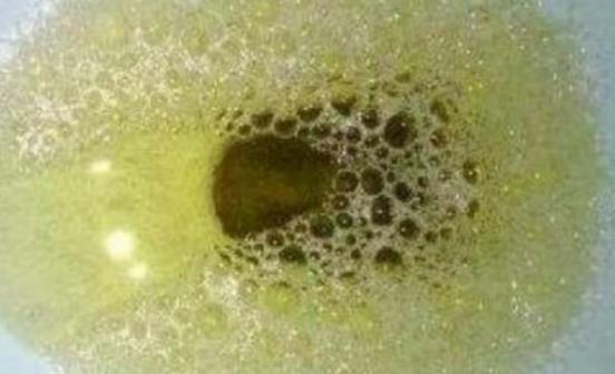 痛风|无论男女，排尿时有“3个异常”，肾脏或早已被“掏空”，尽早检查