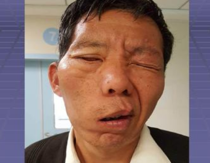 肾病|45岁男子血液黏如粥，脑梗离世，医生：生前这一物吃太多！