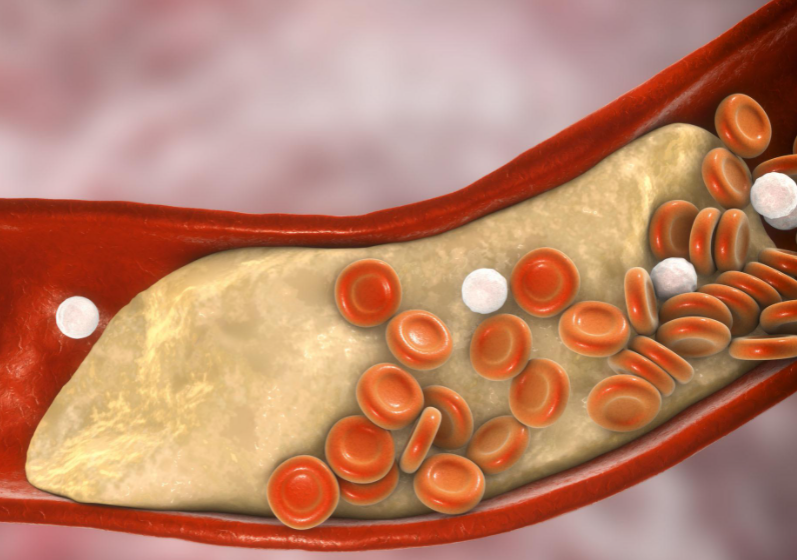饮食|血液的“稀释剂”被发现，老陈醋榜上无名，常吃这一物，血液或清如水