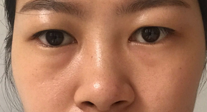 医线天|46岁男子，每日“跑步”养肝，肝昏迷入院，医生怒斥：愚蠢至极！
