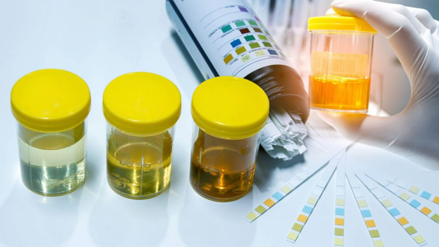 尿酸|尿酸高不高，看小便就知道？内科主任：高尿酸人群，上厕所有3“特征”