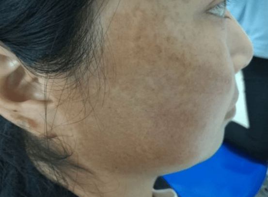 更年期|47岁女子从“黄脸婆”变“少女”,医生:女人懂保养,更年期过成“青春期”