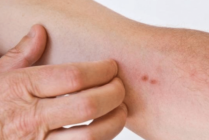 符娜娜星座|42岁男子以为皮肤过敏，却查出肝硬化，医生：身体2处发痒，尽早做检查