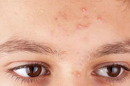 痘痘 希芸带你看,痘痘肌的日常护肤要怎么做?