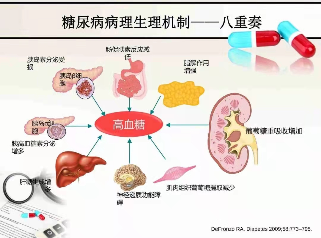 喝咖啡的松子茶 2型糖尿病的病理生理机制演变