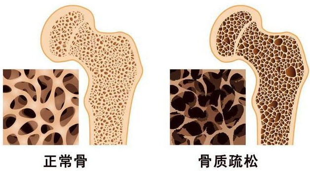 白菜|每1口都是在骨头上打“洞”,数名骨科专家直言:“冰箱1物”,趁早扔掉