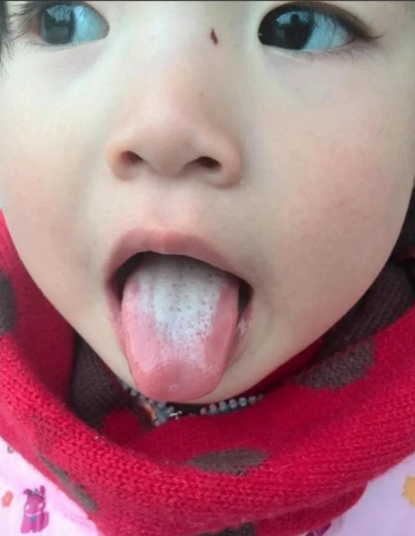睡眠|发现没：孩子有这样的舌苔，是很难长肉长高的
