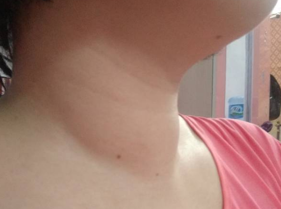 长寿|内分泌主任：比苦瓜还护甲状腺，每天坚持补充一些，或让结节消散