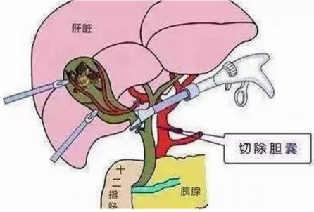 冯中医 胆囊息肉切除胆囊，会有什么影响？