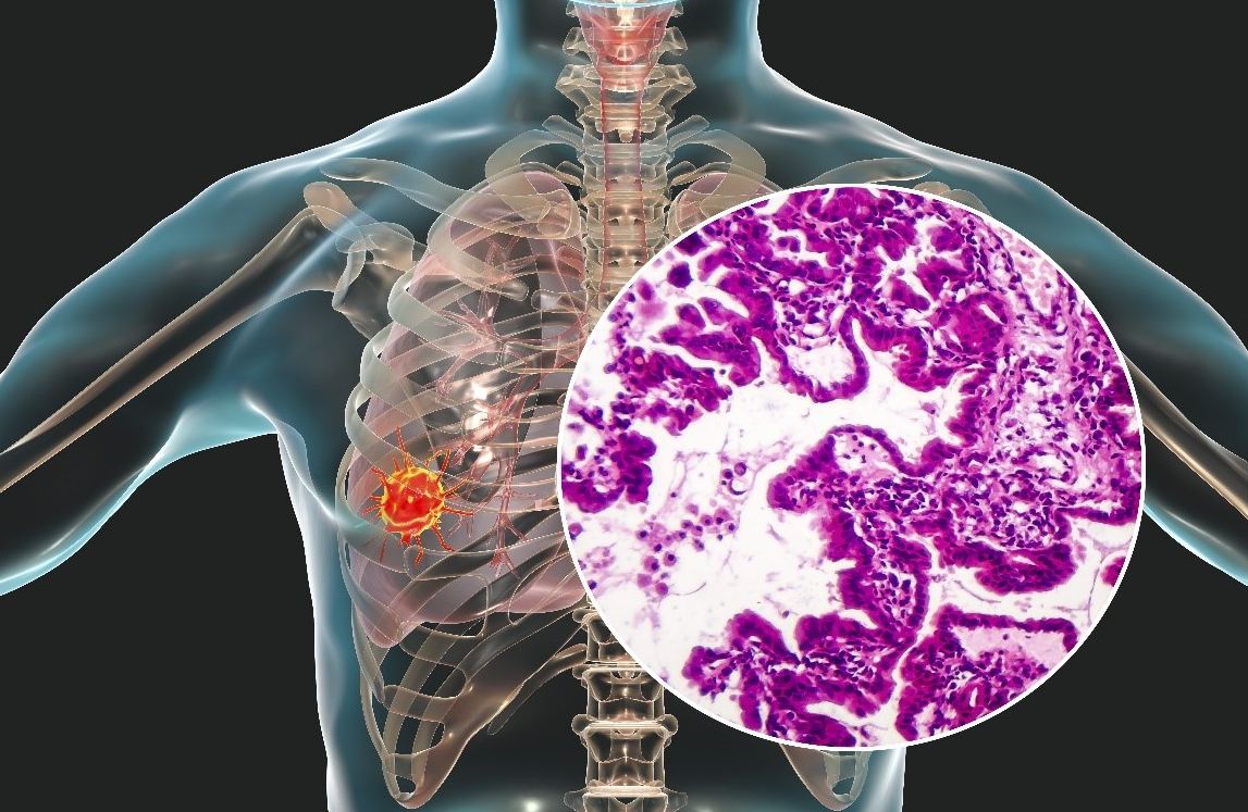 39健康网|肺部的“知音”已找到，并非西红柿，呼吸科主任：你若爱吃，结节或无处藏身