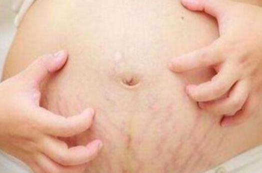 颜建晖说育儿|孕期什么样的孕妈不容易长妊娠纹？