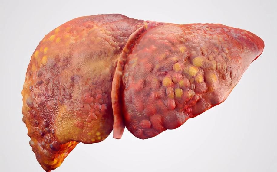 医线天|肝不好的人可以吃牛肉吗？医生提醒：3种食物尽早撤下餐桌