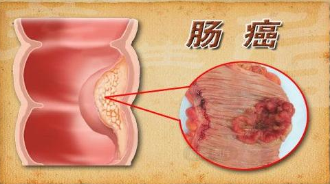 冯中医 为什么定期筛查肠息肉很重要？查出后要如何治疗？