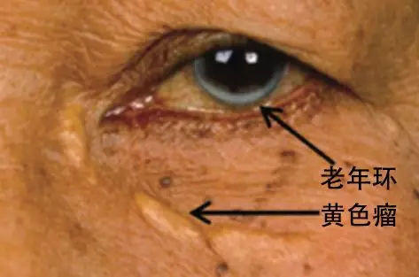 高血脂|手腳是血脂升高的“警示燈”？血脂正常不正常，看3個地方就知道