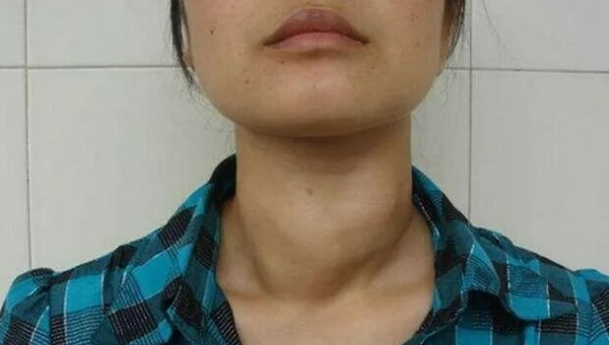 甲状腺肿瘤|爱吸烟的人,“睡觉”出现3异常,多半是甲状腺肿瘤,尽早检查CT