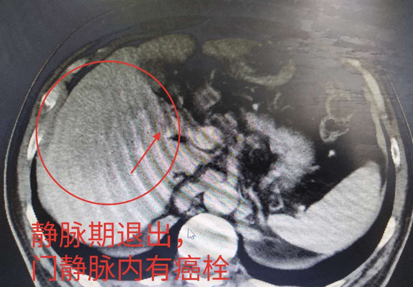 药师芸朵妈妈 不抽烟、不喝酒，一检查却已肝癌晚期，为什么？