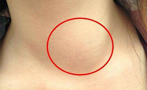 甲状腺癌|中国食品网特别呼吁:冰箱“1物”或致使甲状腺癌变,趁早扔掉