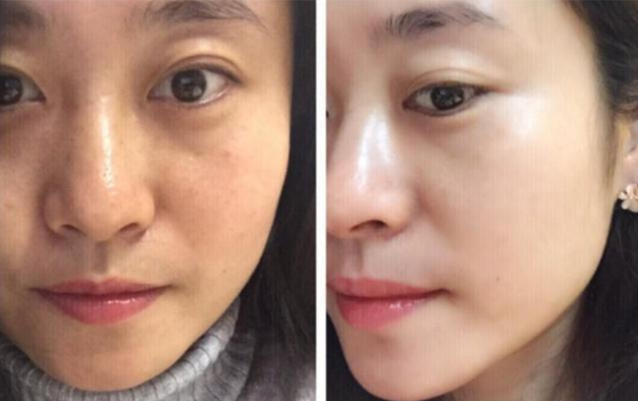 黑色素|国外女子连打6年美白针，如今皮肤发生什么变化？网友：难以相信