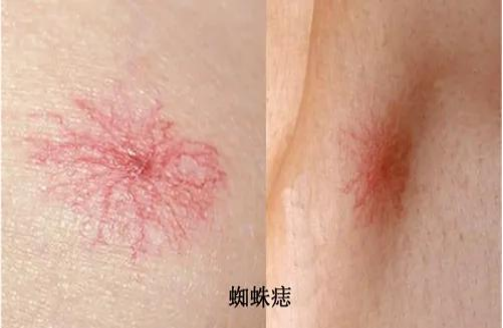 肝臟|每吃一口近似在肝上打洞，院士呼吁：1“下酒菜”，或比肥肉還傷肝