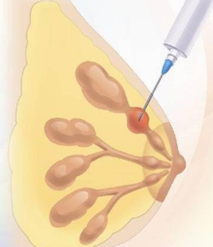 胡凤山 乳腺癌-筛查：乳腺癌筛查需要做什么？