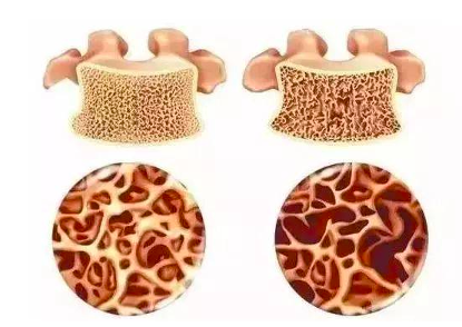 天天听健康|黑豆是骨质疏松的“发物”？医生：常吃3种食物，或是自毁骨头